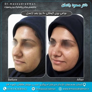 جراحی-بینی-در-کرمان-51