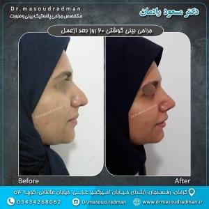 جراحی-بینی-در-کرمان-52
