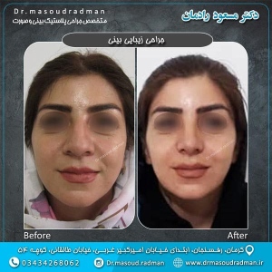 جراحی-بینی-در-کرمان-55