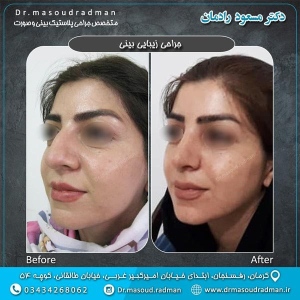 جراحی-بینی-در-کرمان-56