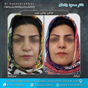 جراحی-بینی-در-کرمان-59