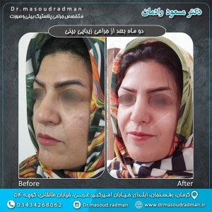 جراحی-بینی-در-کرمان-60