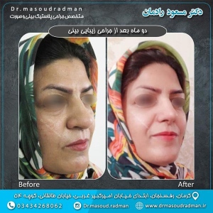 جراحی-بینی-در-کرمان-61