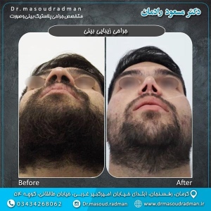 جراحی-بینی-در-کرمان-63