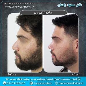 جراحی-بینی-در-کرمان-66