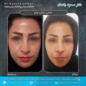 جراحی-بینی-در-کرمان-68