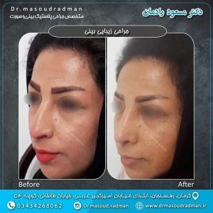 جراحی-بینی-در-کرمان-73