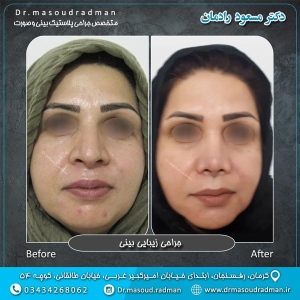 جراحی-بینی-در-کرمان-81