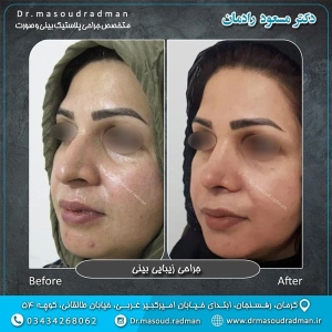 جراحی-بینی-در-کرمان-83