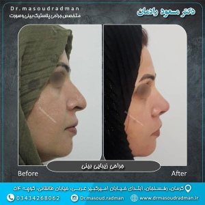 جراحی-بینی-در-کرمان-85