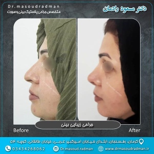 جراحی-بینی-در-کرمان-86