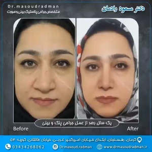 جراحی-بینی-در-کرمان-94