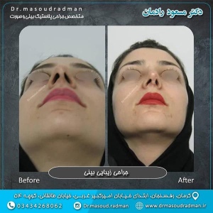 جراحی-بینی-در-کرمان-96