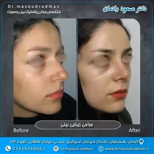 جراحی-بینی-در-کرمان-97