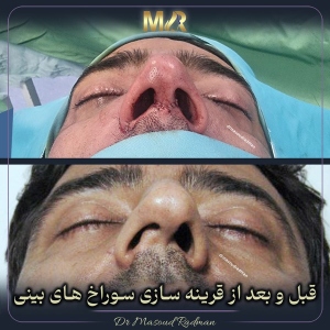 جراحی-بینی-468