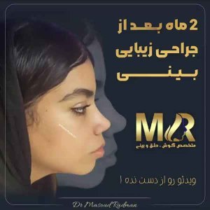 جراحی-بینی-471