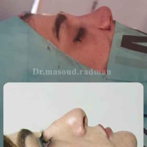 جراحی-بینی-477