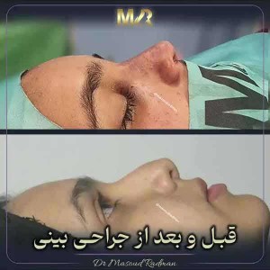 جراحی-بینی-479