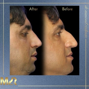 1_rhinoplasty-764