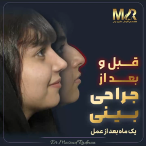 جراحی-بینی-483