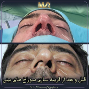 جراحی-بینی-485