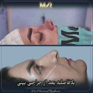 جراحی-بینی-491