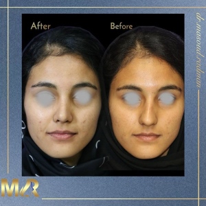 rhinoplasty-765