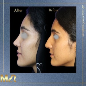rhinoplasty-766