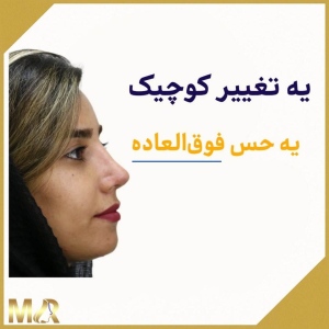 rhinoplasty-780
