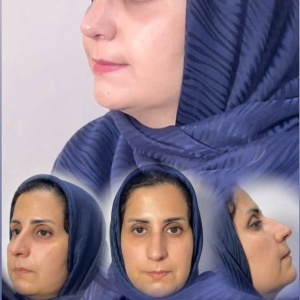 rhinoplasty-782