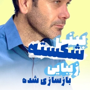 rhinoplasty-783