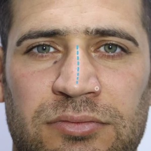 rhinoplasty-785