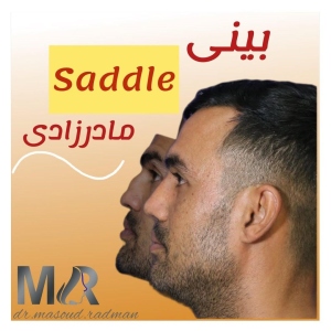 rhinoplasty-789