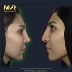 rhinoplasty-791