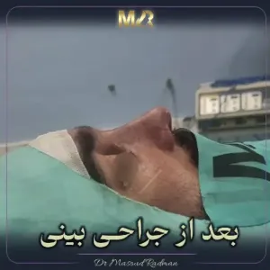 rhinoplasty-792