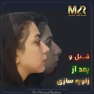 rhinoplasty-793