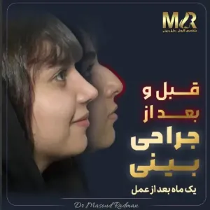 rhinoplasty-794