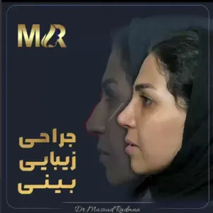 rhinoplasty-795