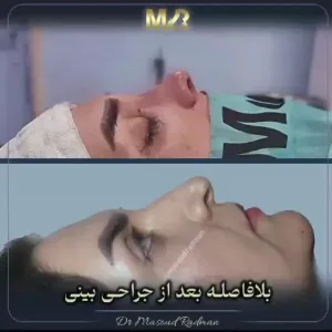 rhinoplasty-796
