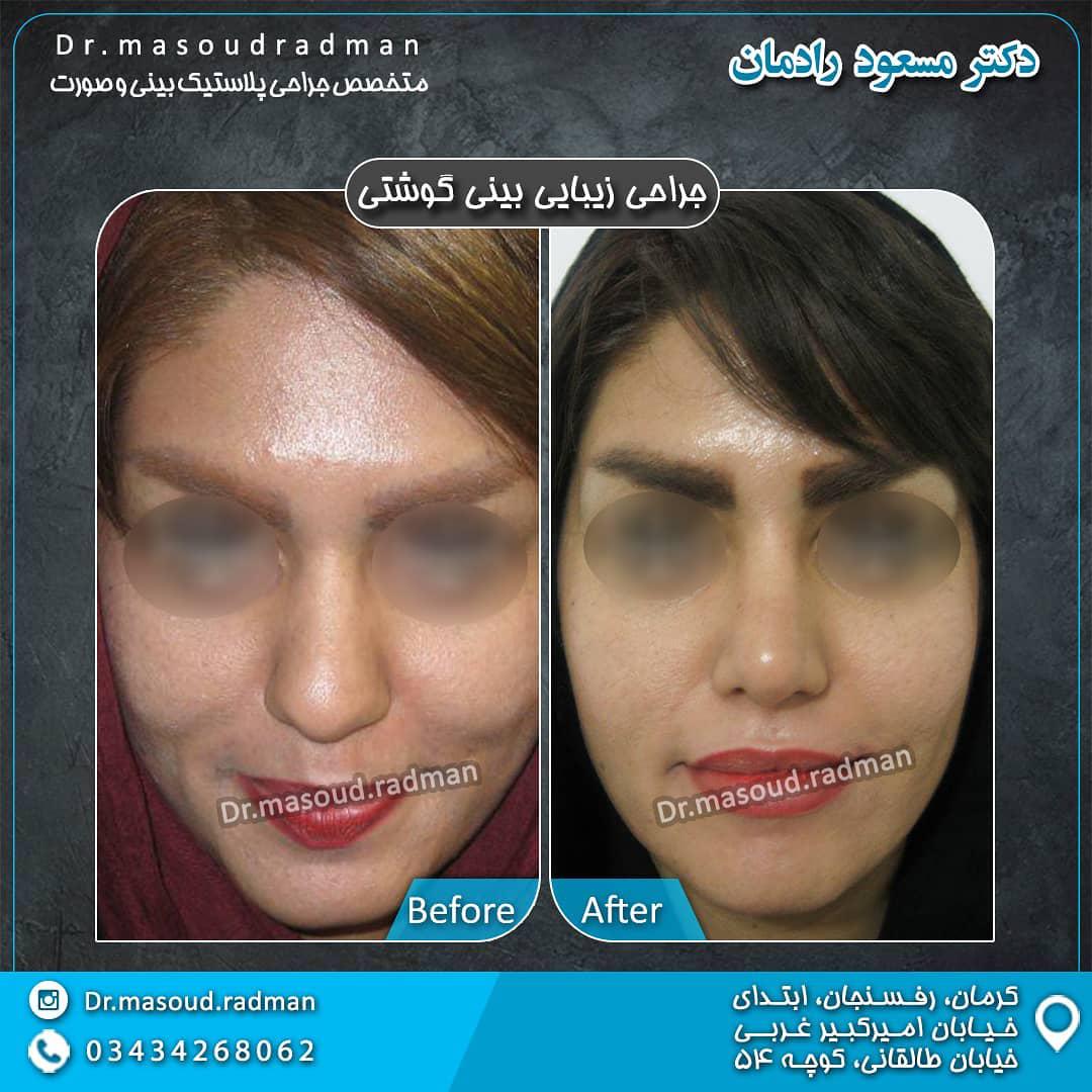 جراحی بینی باز