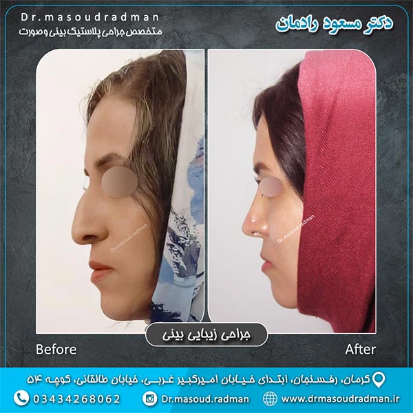 جراحی بینی