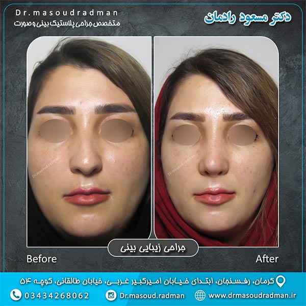 جراحی بینی