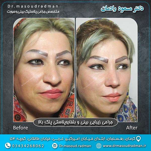 جراحی بینی