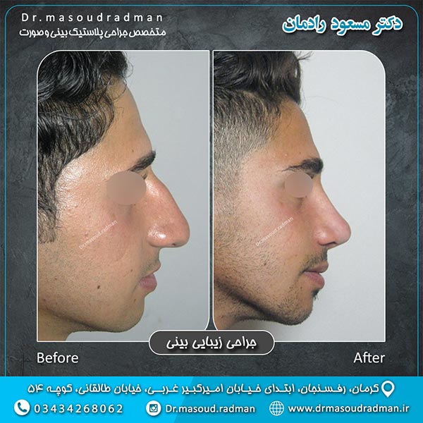 جراحی بینی