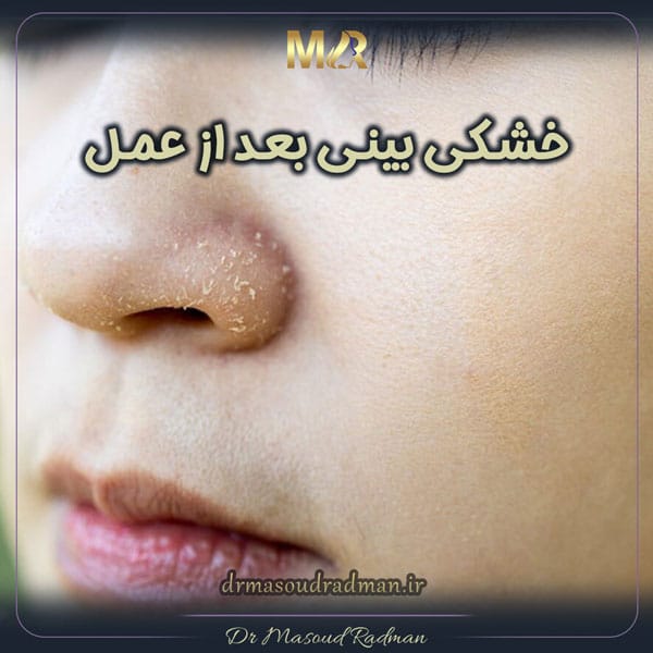 خشکی بینی بعد از عمل
