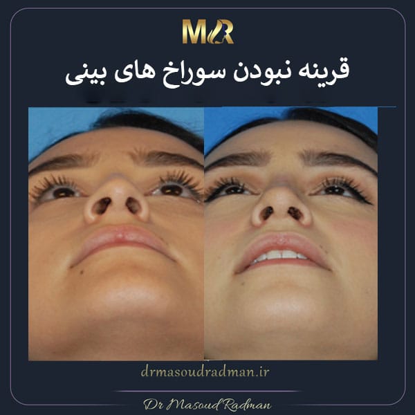 قرینه نبودن سوراخ های بینی