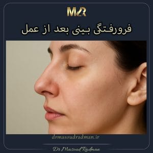 فرورفتگی بینی بعد از عمل