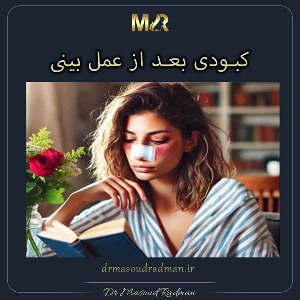کبودی بعد از عمل بینی - دکتر مسعود رادمان