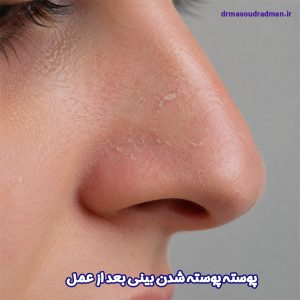 پوسته پوسته شدن بینی بعد از عمل - دکتر رادمان