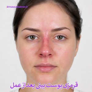 قرمزی پوست بینی بعد از عمل - دکتر رادمان